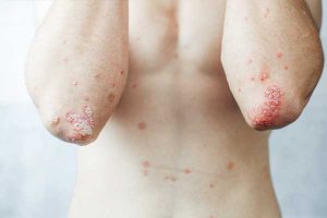 Psoriasis Behandlungen